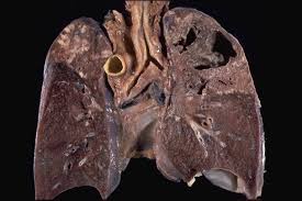 Pulmonary Tuberculosis