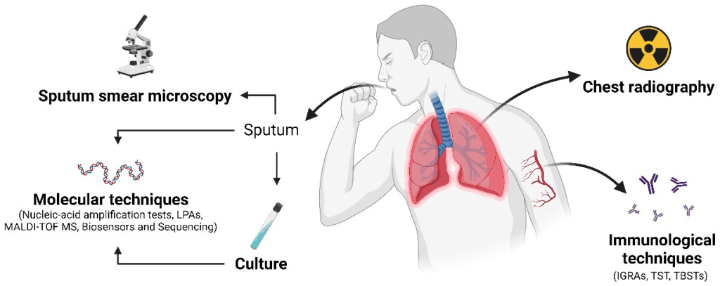 pulmonary tuberculosis diagnosis
